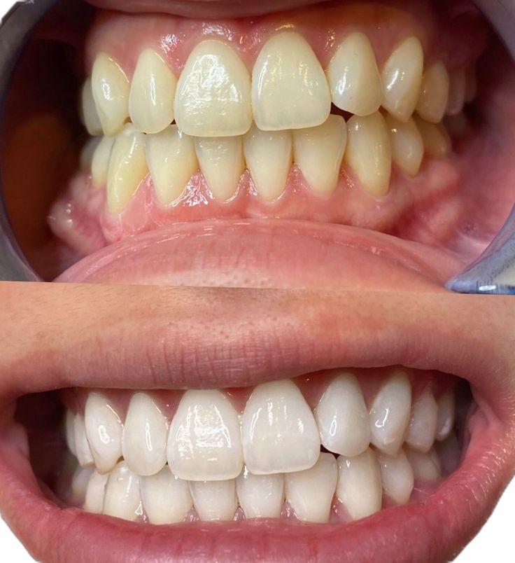 Guru Nanda  Premium Teeth Whitening Strips