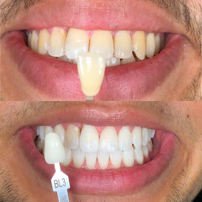 Guru Nanda  Premium Teeth Whitening Strips