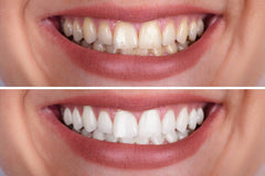 Guru Nanda  Premium Teeth Whitening Strips