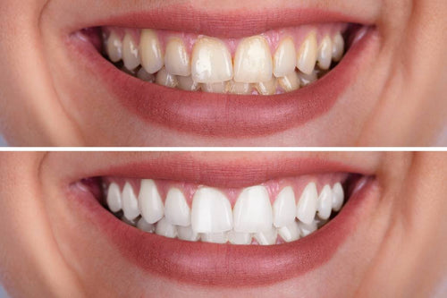 Guru Nanda  Premium Teeth Whitening Strips
