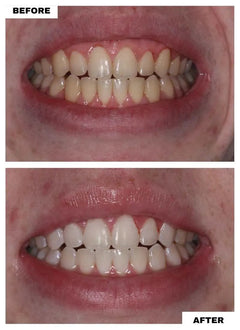 Guru Nanda  Premium Teeth Whitening Strips